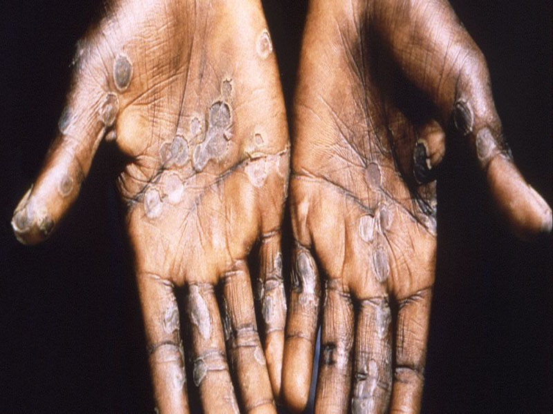 © CDC. Las lesiones por viruela del mono suelen aparecer en las palmas de las manos.