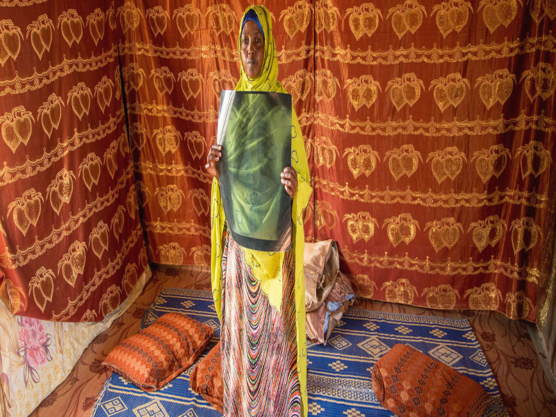 PNUD/Aurélia Rusek Una refugiada somalí a la que se le diagnosticó tuberculosis en 2017 muestra una radiografía de tórax en un campamento de Djibouti donde vive con su familia.