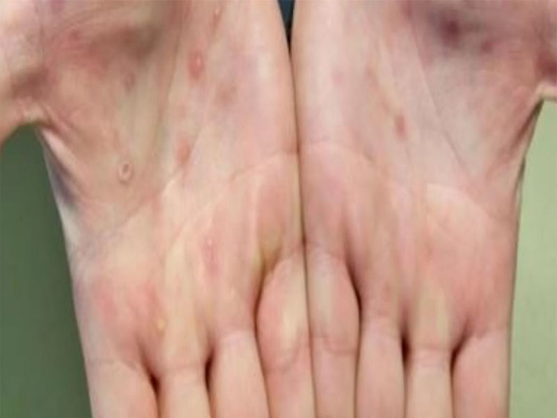 CDC. Las lesiones de la viruela del mono suelen aparecer en las palmas de las manos